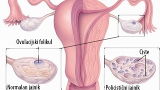Šest važnih činjenica o PCOS-u