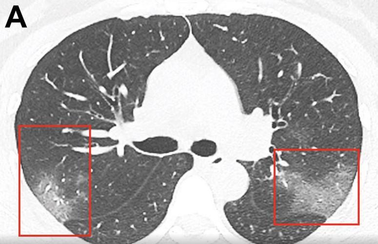 Objavljen CT snimak: Ljekari pokazali šta koronavirus radi ljudskim plućima