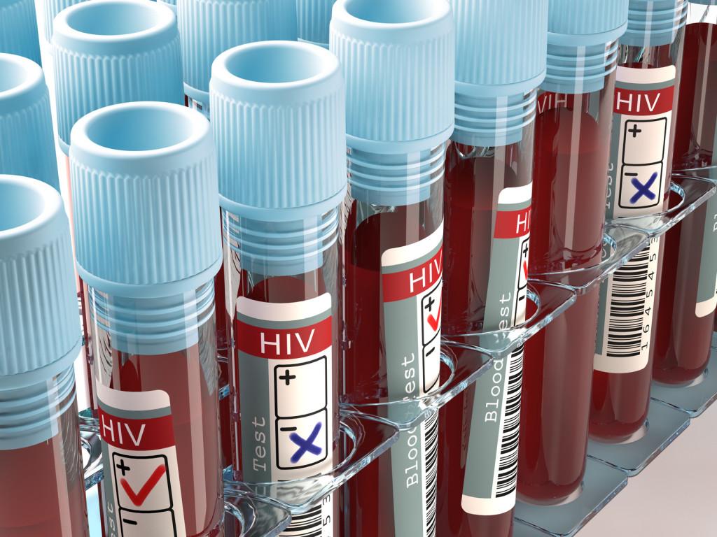 Kako se manifestira HIV: Smrtonosna bolest koja oštećuje imunološki sistem