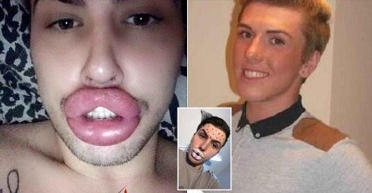 Potrošio 15.700 eura da bi imao savršene usne: Morao ih smanjiti jer bi mu eksplodirale