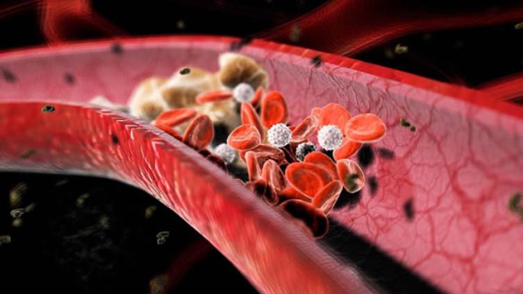Kako lako sniziti holesterol u krvi