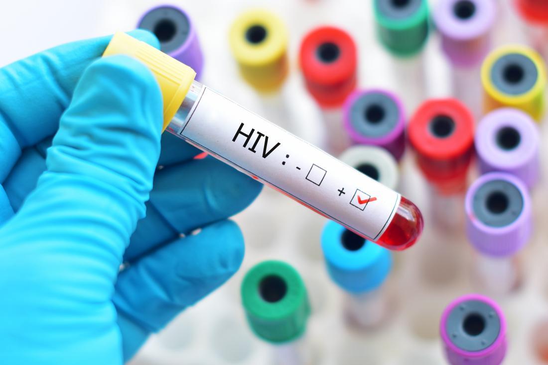 Smatra se da HIV uzrokuje upalu krvnih žila - Avaz