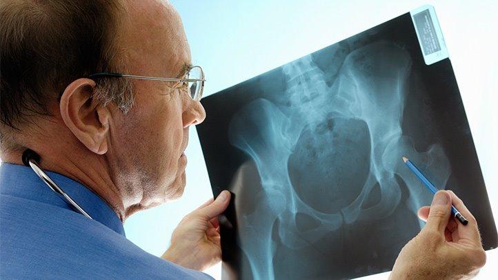 Nastanku osteoporoze može doprinijeti i hronični nedostatak vitamina D - Avaz