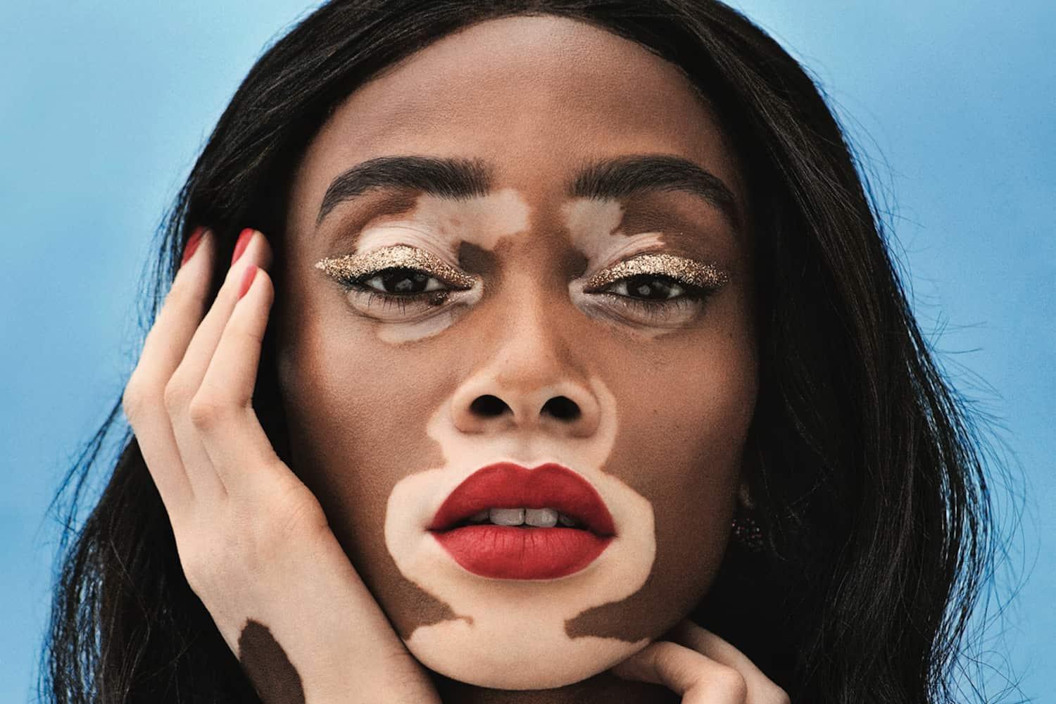 Bori se s vitiligom, a postala je zvijezda prestižnog magazina