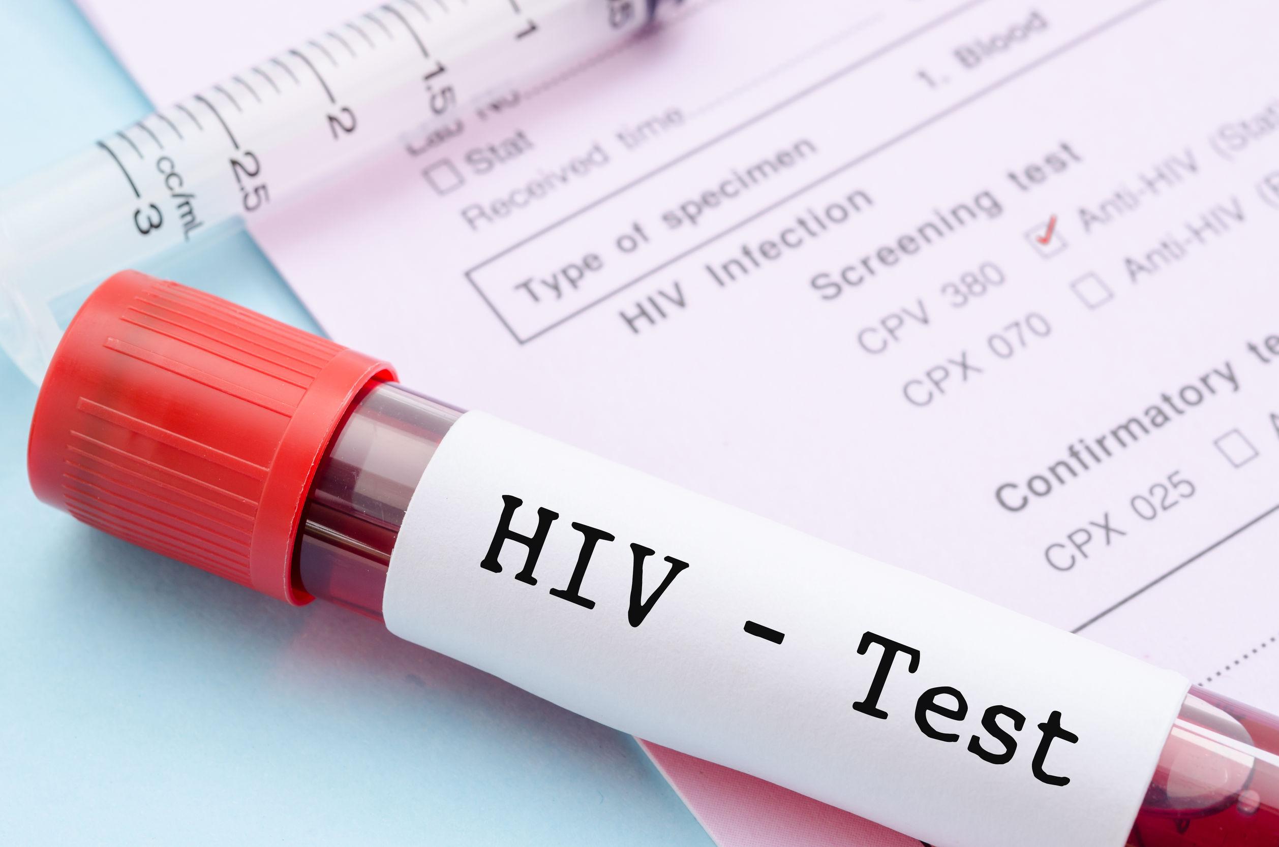 Testovi nisu pokazali tragove HIV virusa kod muškarca koji je prethodno imao AIDS - Avaz