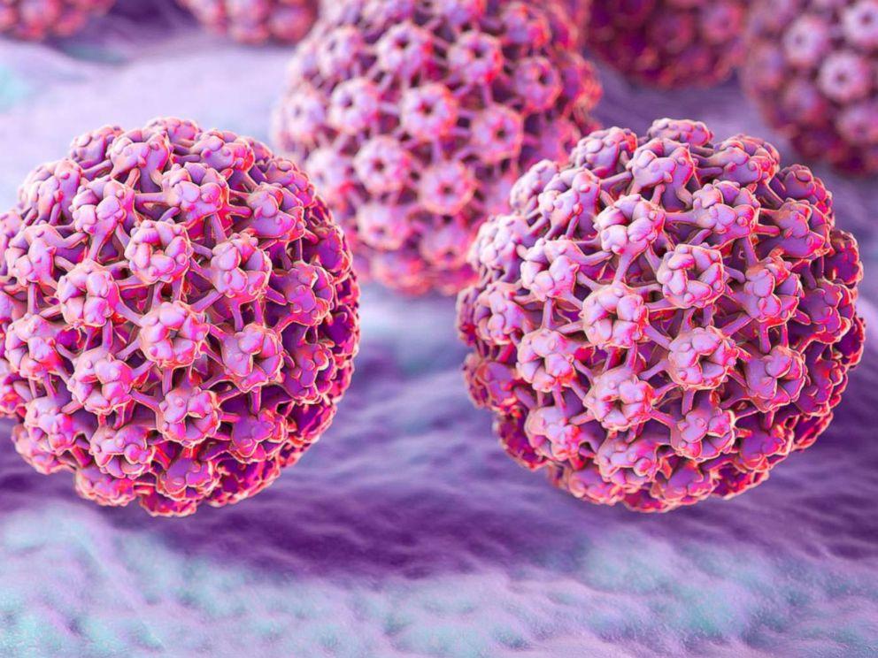 Tipovi HPV-a visokog rizika mogu uzrokovati intraepitelne lezije - Avaz