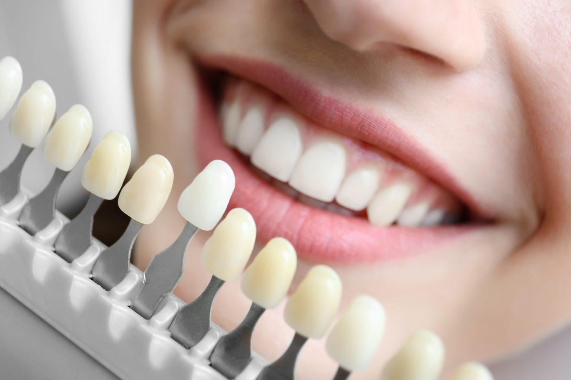 Zadovoljavajućim protetskim radom na prednjim zubima smatra se keramička nadogradnja i kruna - Avaz