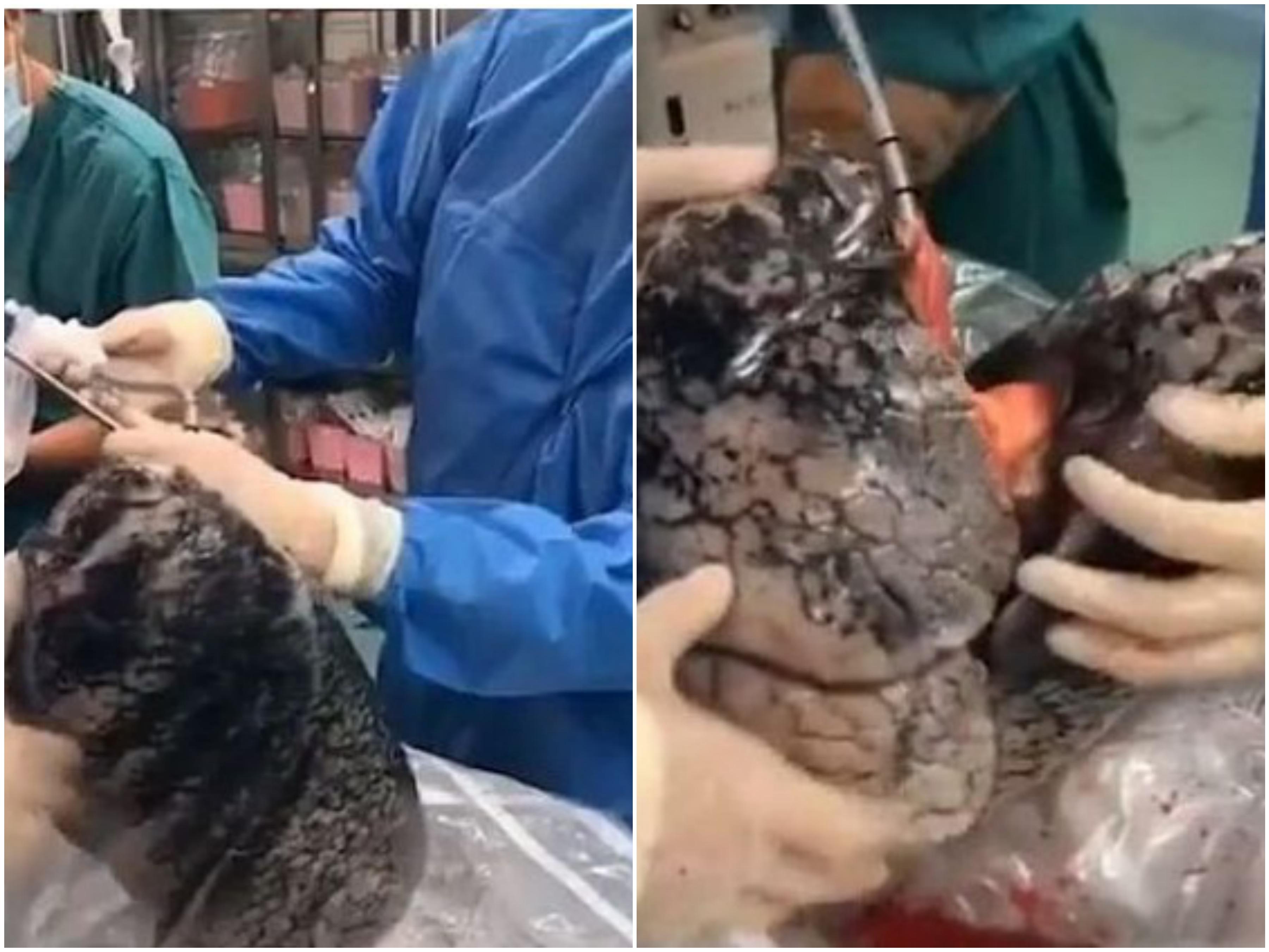 Ljekari u Kineskoj bolnici Wuxi u Đansu izvadili su pluća čovjeku koji je preminuo - Avaz