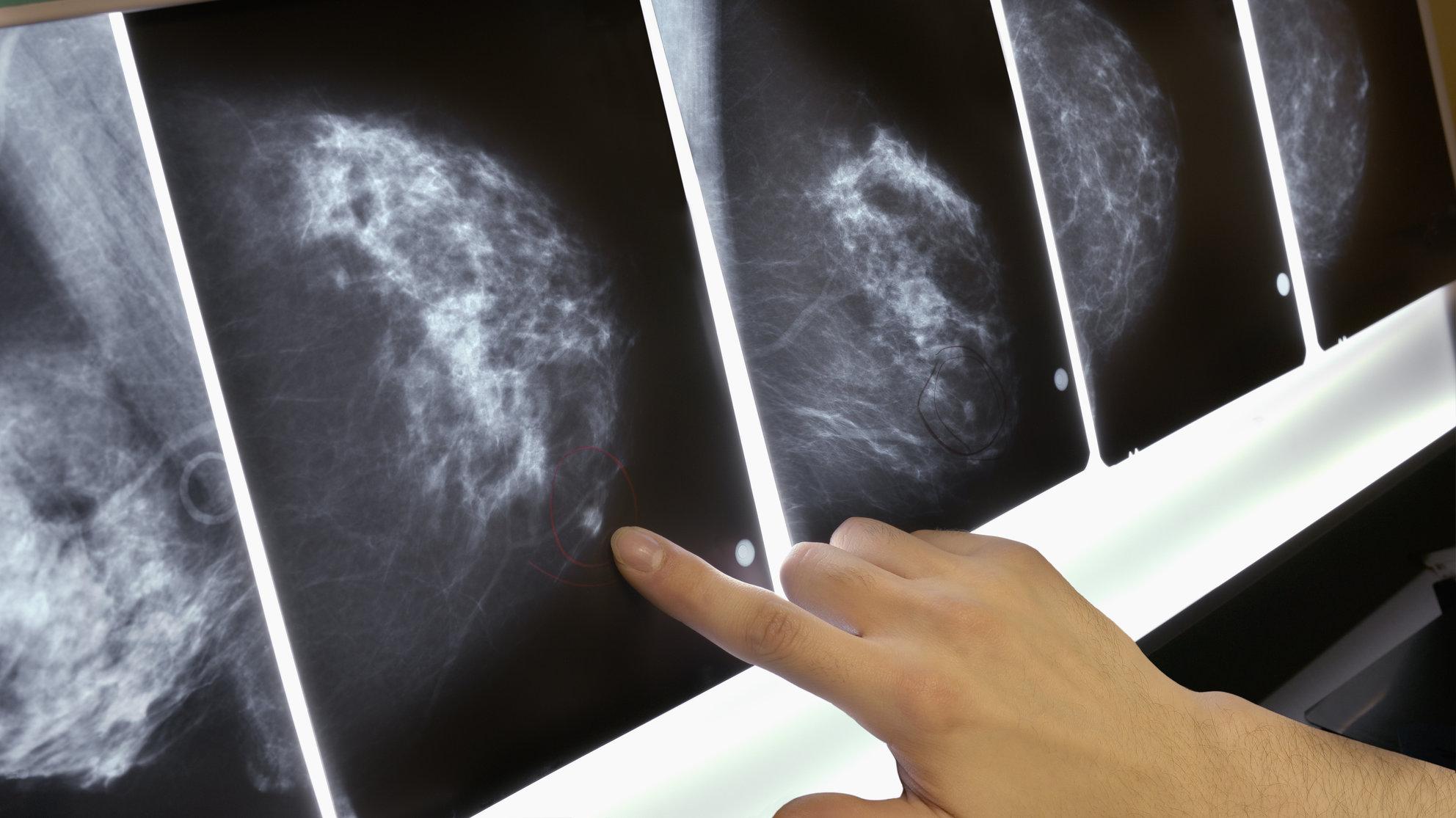 Spas za oboljele: Novi lijek mjesecima zaustavlja napredovanje metastatskog raka dojke