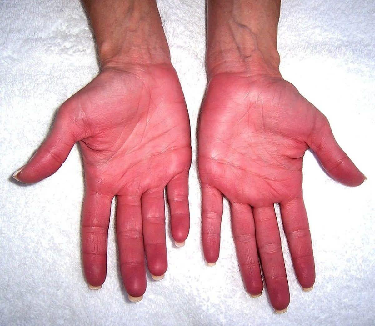 Mogući razlog pojave crvenih dlanova je promjena u hormonskoj ravnoteži - Avaz