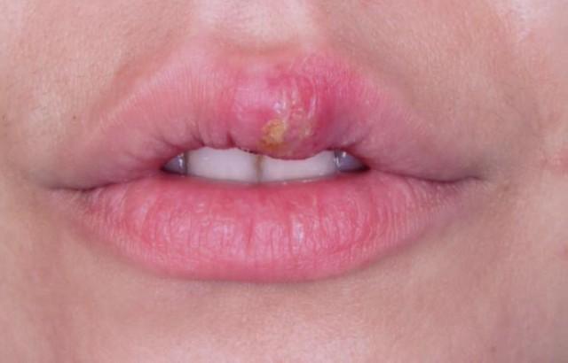 Herpes na usni - šta ga izaziva i kako ga spriječiti?