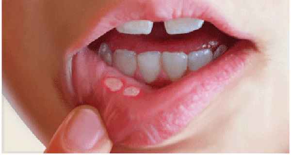Afte su bijele ranice u ustima koje mogu biti vrlo neugodne - Avaz