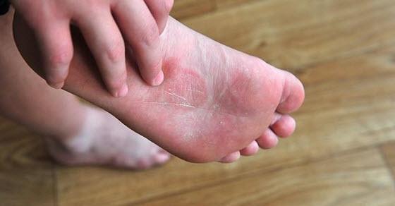 pet posto ljudi ima gljivično oboljenje stopala - Avaz