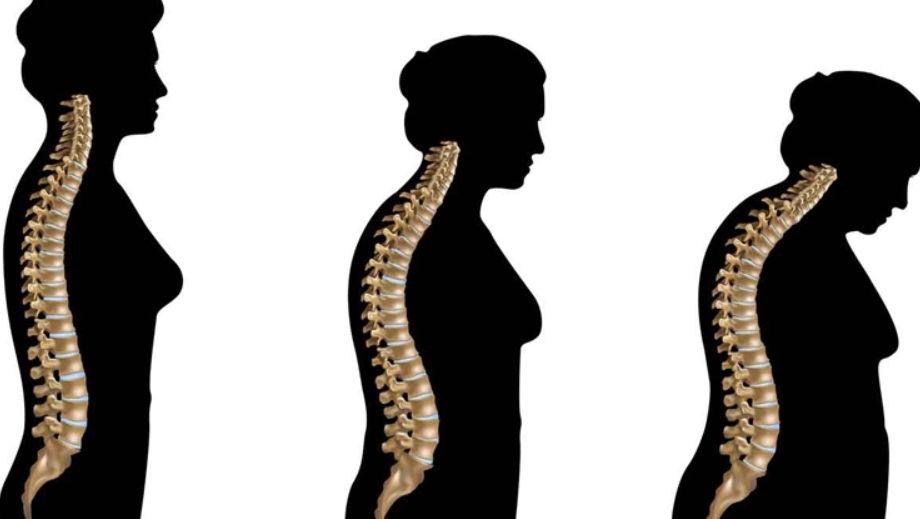 Osteoporoza može dovesti do smanjene pokretljivosti - Avaz