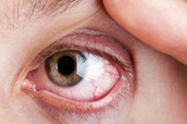 Naučite spriječiti iritaciju oka - Avaz