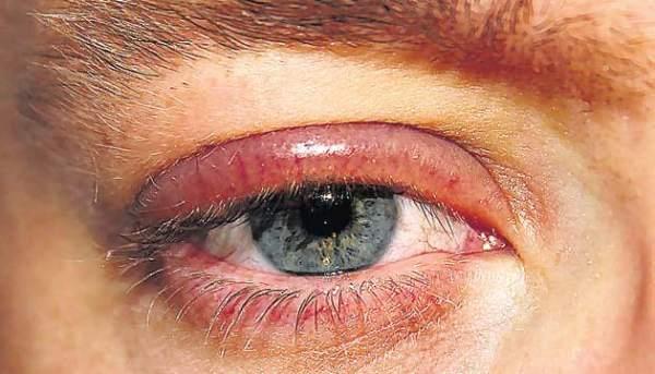 Infekcija oka može da bude simptom COVIDA - 19 - Avaz