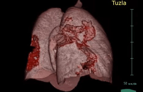 Pogledajte snimak šta Covid-19 može uraditi plućima zaraženog pacijenta