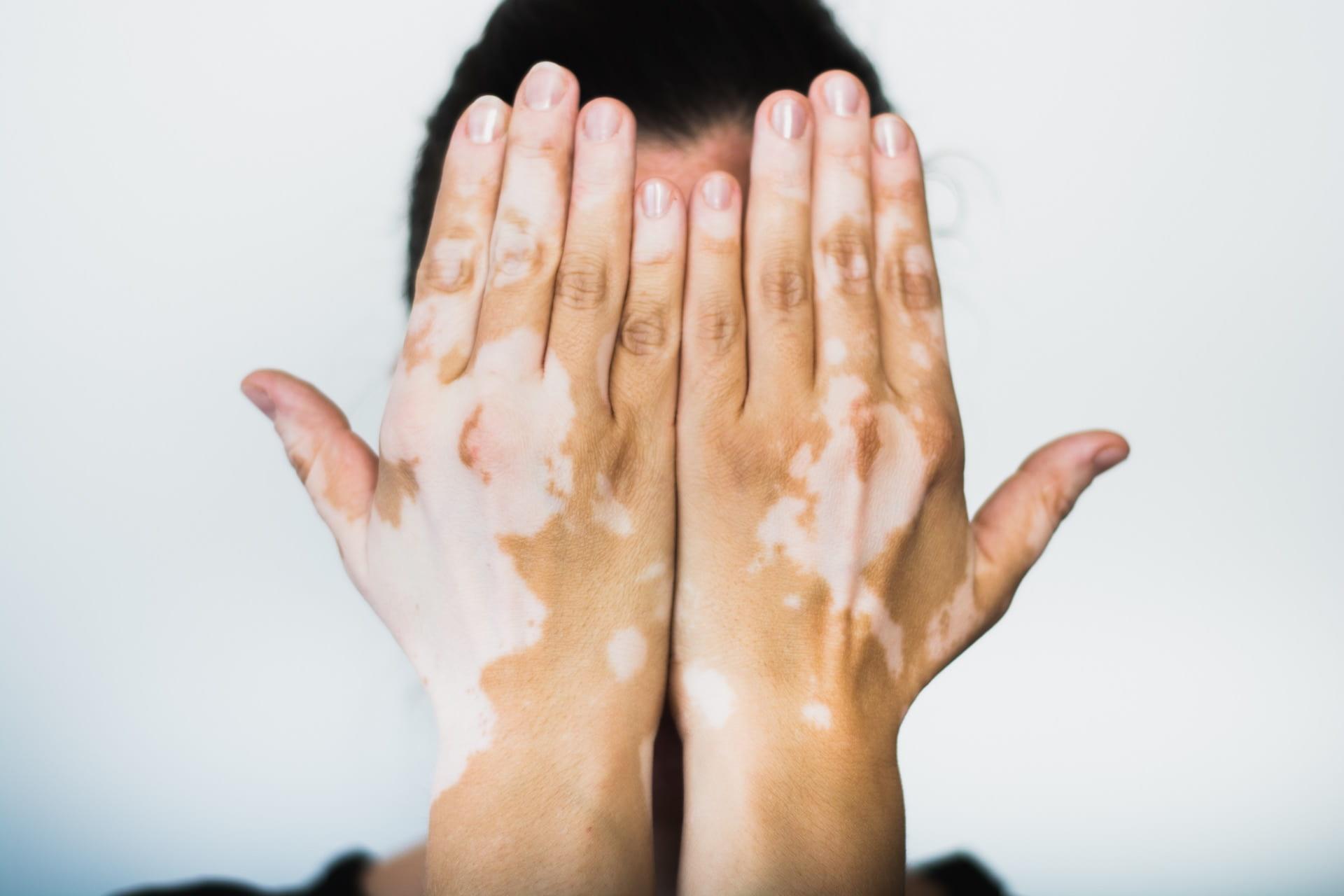 Bolest bijelih mrlja: Vitiligo nije samo oboljenje kože