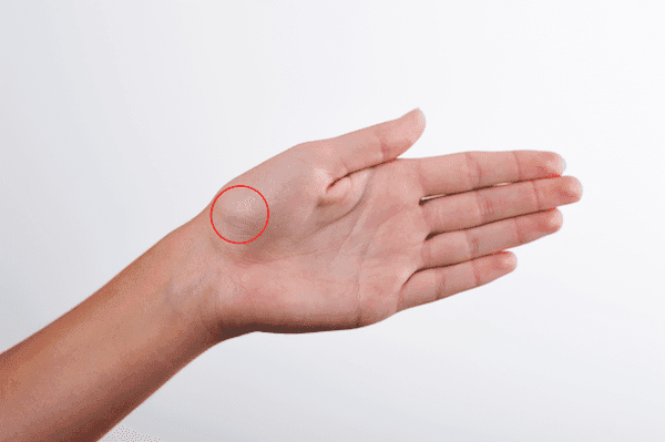 Ove ciste se najčešće javljaju na gornjoj i donjoj strani ručnog zgloba - Avaz
