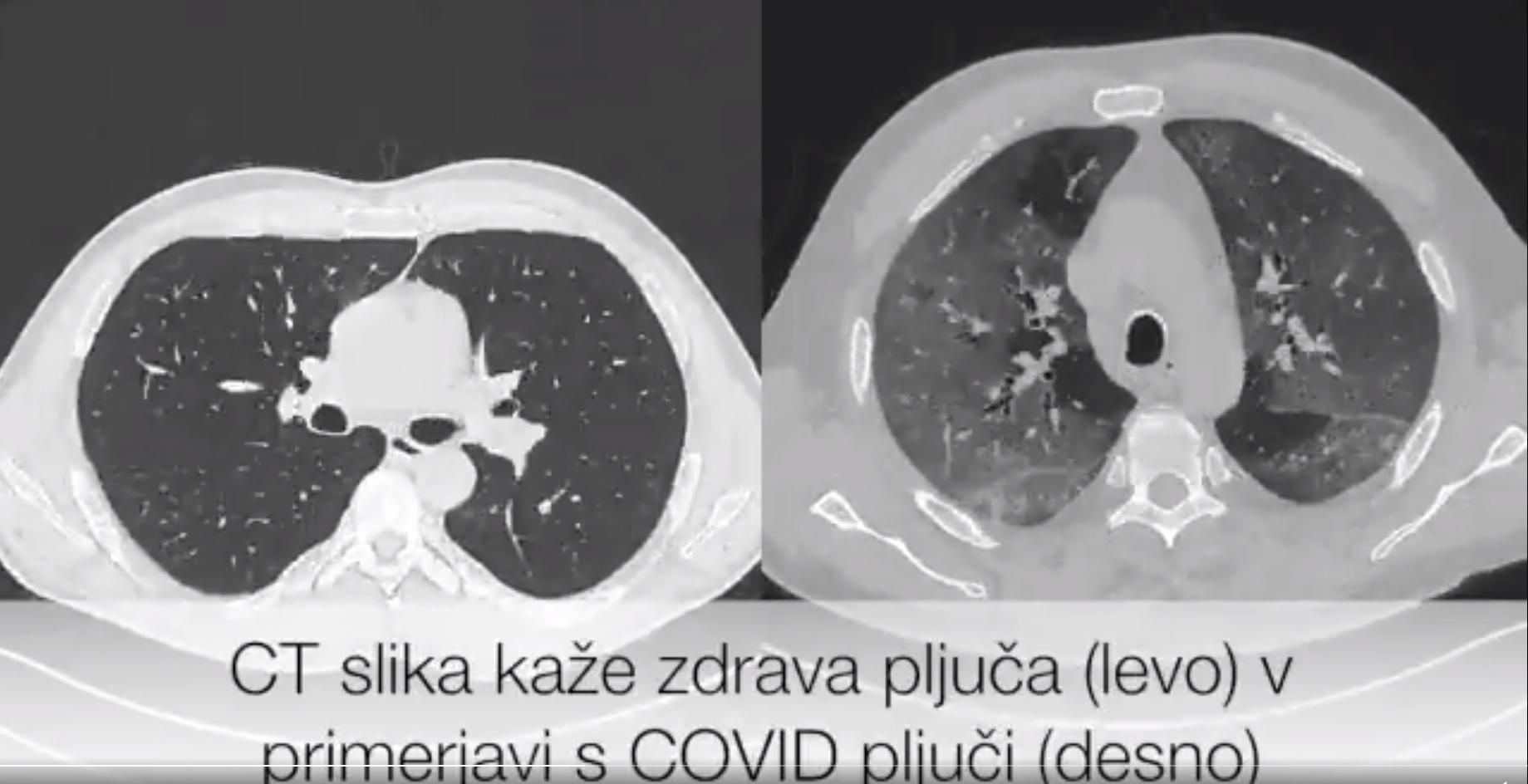 Pogledajte kako izgledaju pluća osobe s koronavirusom nasuprot zdravih pluća
