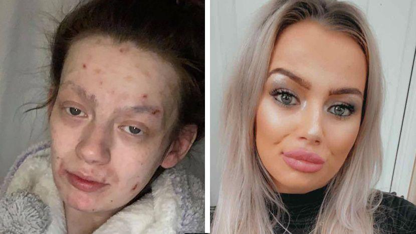 Drogirala se dvije godine, poslije četiri mjeseca bez droge izgleda kao druga osoba