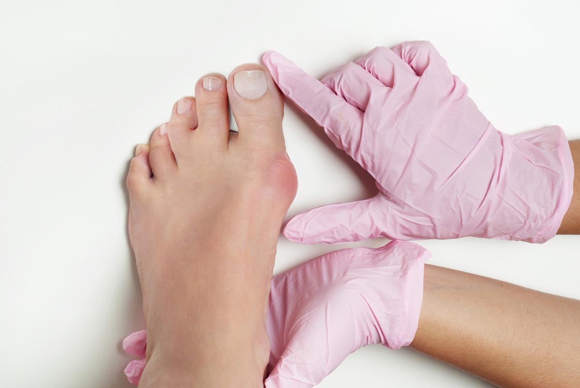 Kako spriječiti vanjsku devijaciju palca stopala