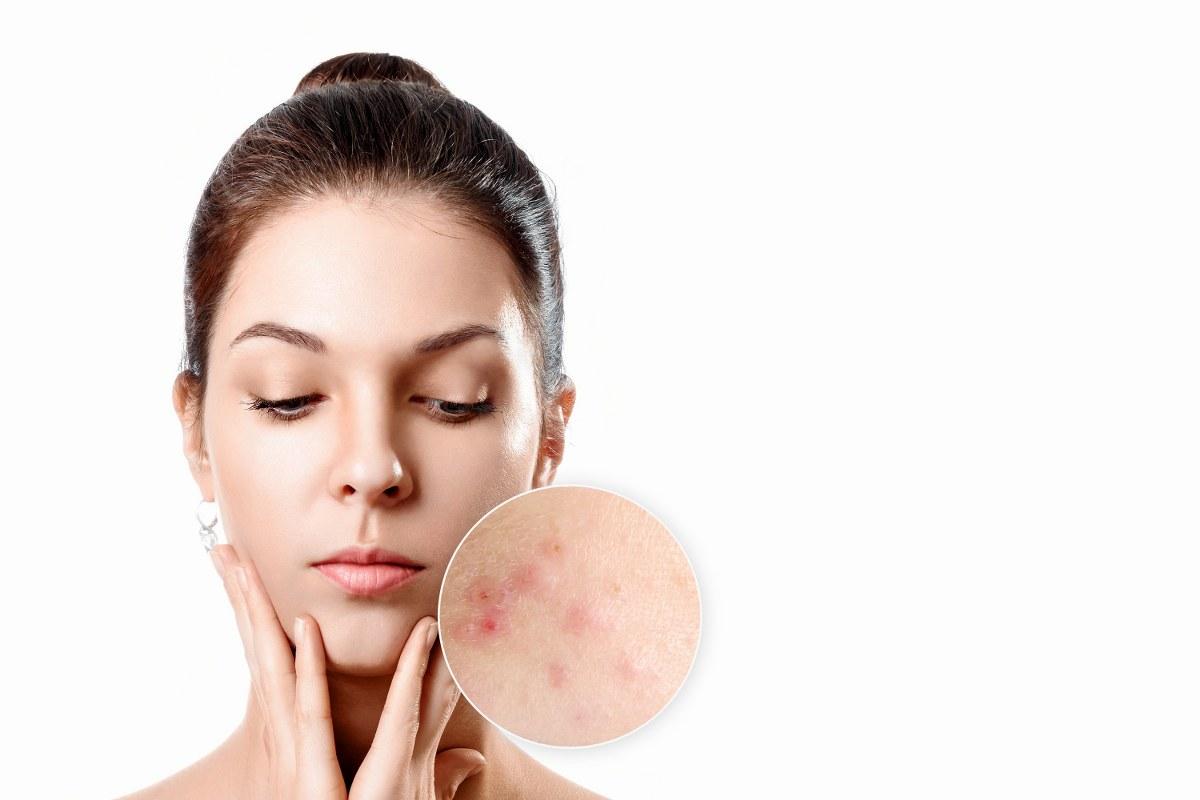 Jedan su od najčešćih problema na koži: Zašto nastaju akne i kako se liječe