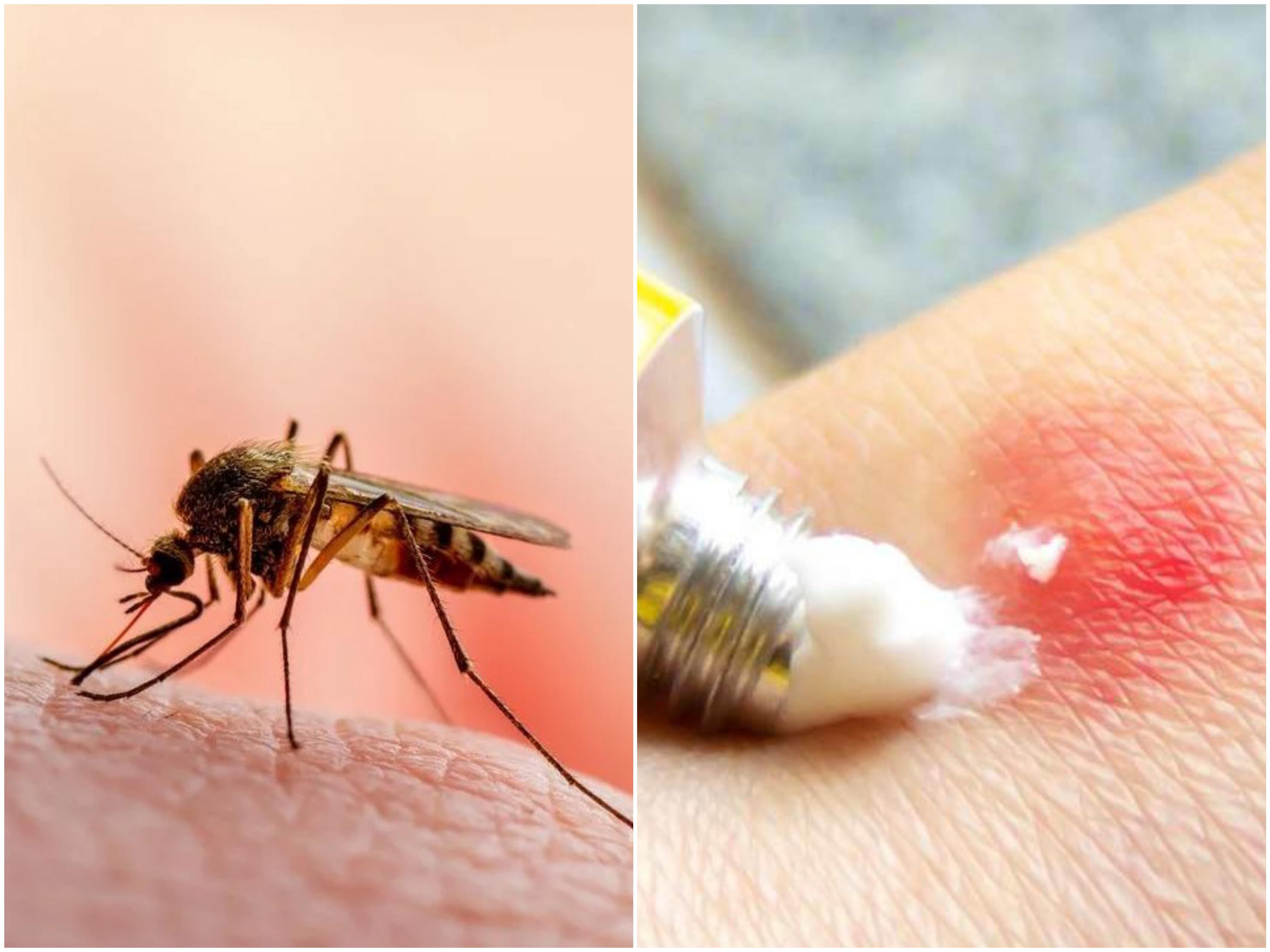 Imunologinja otkrila efikasno sredstvo u borbi protiv svraba nakon uboda komarca