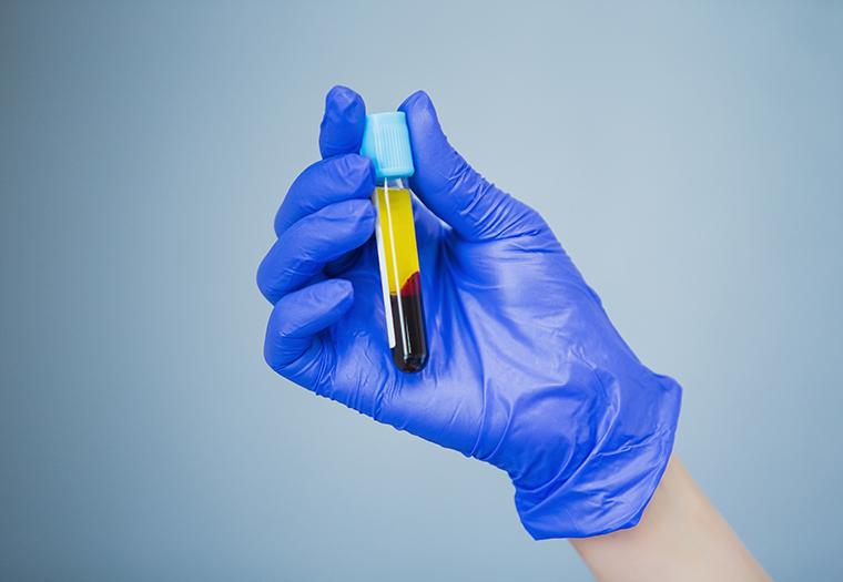Naučnici su analizirali uzorke krvne plazme 54 zdravstvena radnika - Avaz