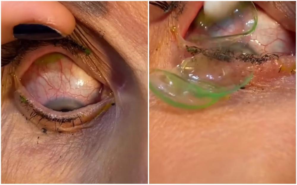 Uznemirujući video: Doktorica izvadila 23 sočiva iz oka pacijentice