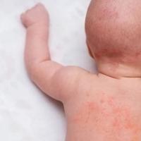 Kako liječiti osip kod novorođenčeta: Nemojte koristiti nikakav sapun