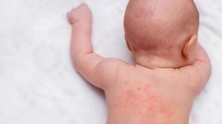 Kako liječiti osip kod novorođenčeta: Nemojte koristiti nikakav sapun