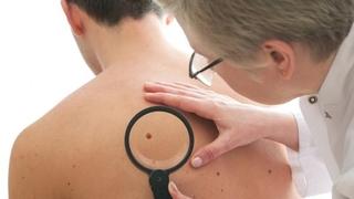 Istraživanje: Najsmrtonosniji oblik raka kože nije melanom