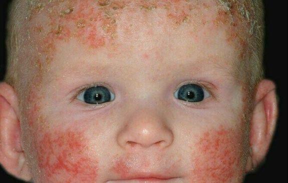Atopisjki dermatitis Djeca - Avaz