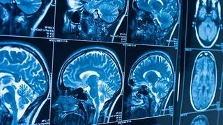 Inovativna terapija ulijeva nadu da će biti pronađen lijek za najsmrtonosniji oblik raka mozga
