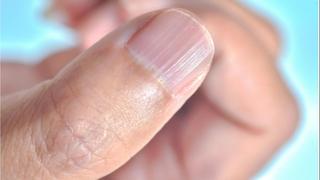 Imate bijele mrlje na noktima: Evo koji su mogući uzroci