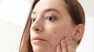 Da li prljava kosa utječe na pojavu akni: Frizer poznatih ličnosti otkriva istinu