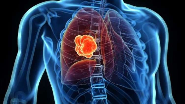 Kako izliječiti rak pluća