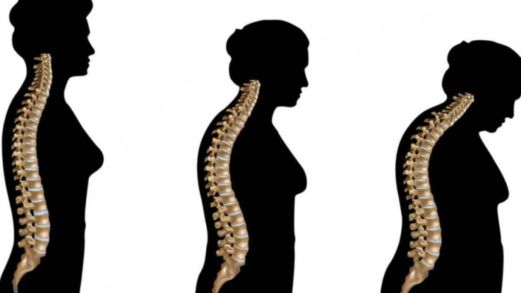 Osteoporoza može dovesti do smanjene pokretljivosti - Avaz, Dnevni avaz, avaz.ba