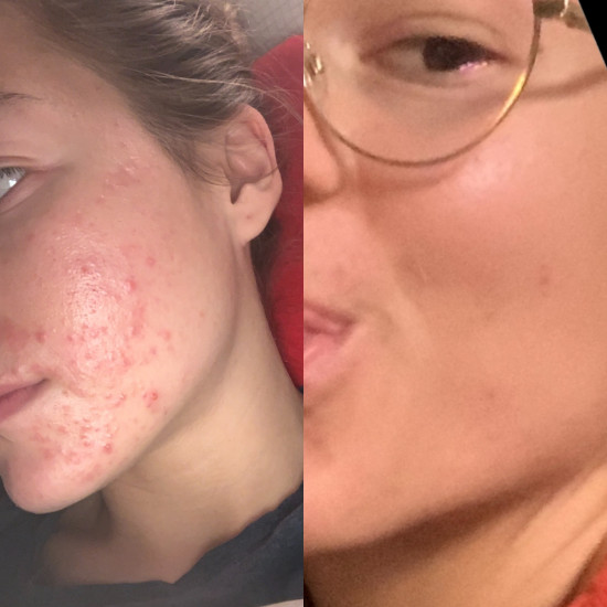 Prije i poslije tretmana