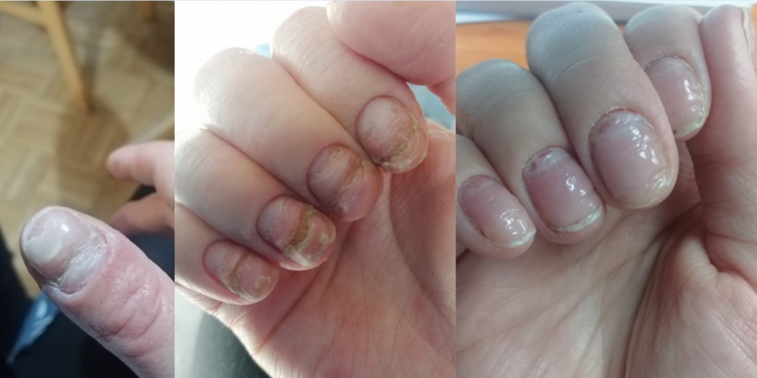 Prije i poslije tretmana